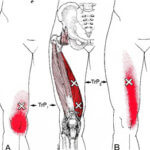 膝の痛みトリガーポイント