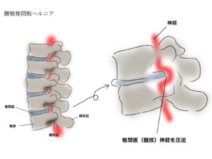 腰の椎間板の図